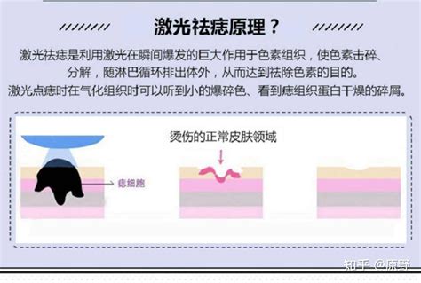 如何消痣|祛痣不要用激光！皮肤科医生告诉你正确的方法